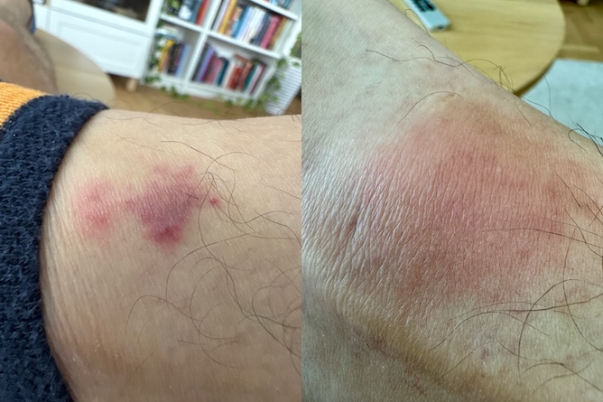 tick bite
